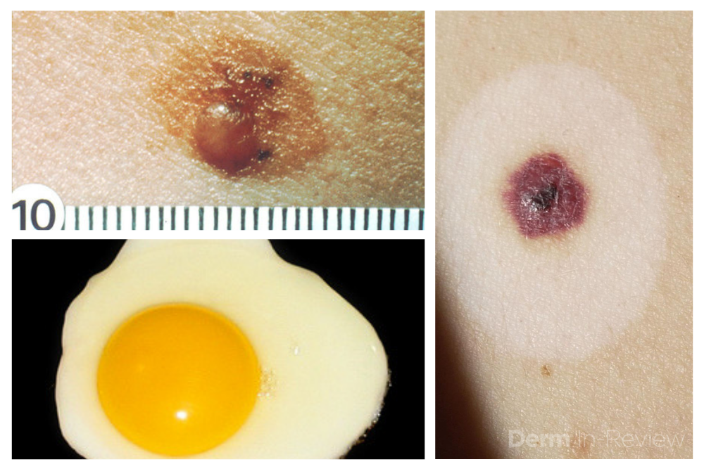 Atypical Nevi on Patient leg