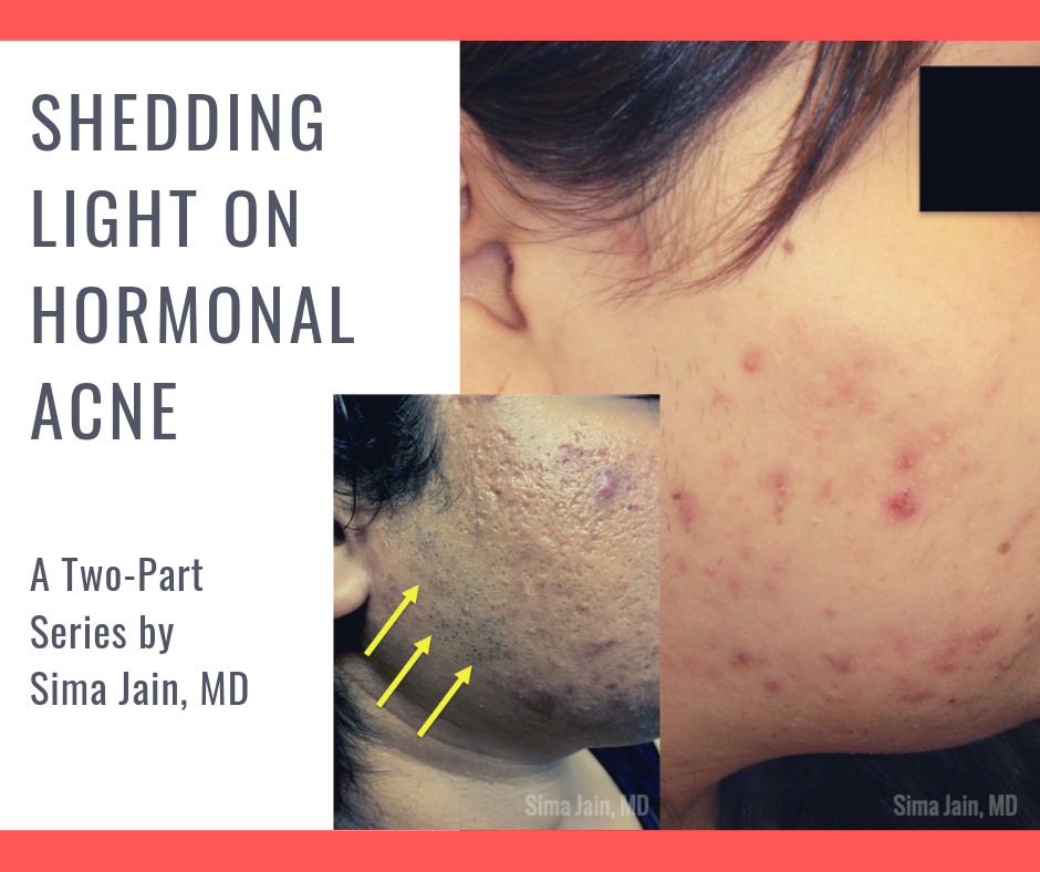 Hormonal Acne Patient Image