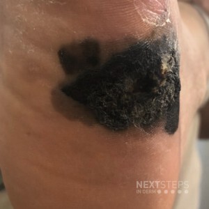 Melanoma on Patient