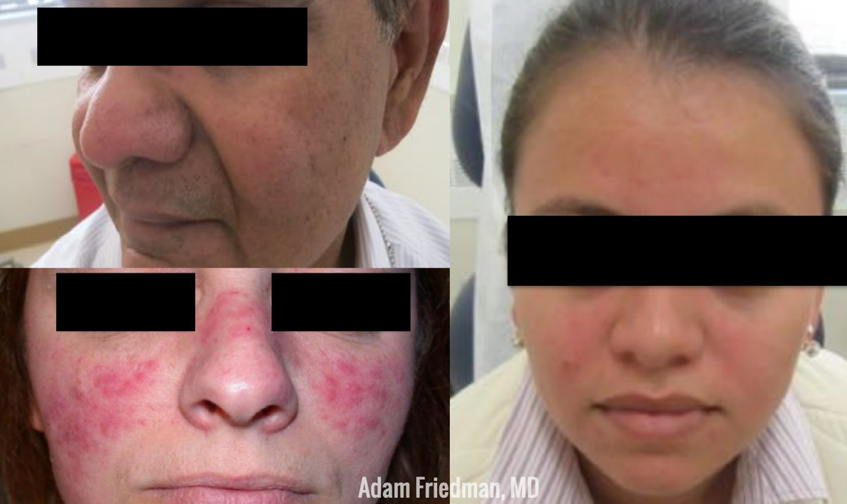 Dermatology Patient with Rosacea