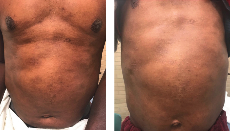 atopic dermatitis, post-inflammatory hyperpigmentation and apparent hyperpigmentation