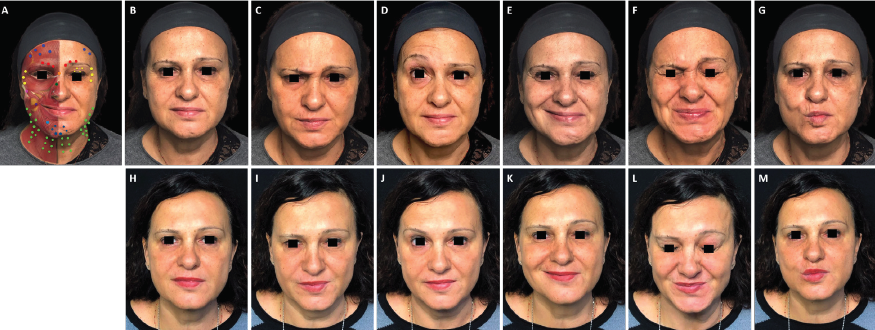 onabotulinumtoxinA in a patient with facial palsy